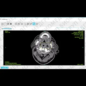 Медицинское программное обеспечение TeleStroke