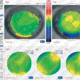 Schwind Combi wavefront analyzer Корнеотопограф