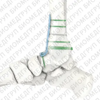 Костная пластина для артродеза для щиколотки ARIX 3.5
