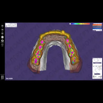 Exocad Bite Splint Module  модуль для создания терапевтических капп