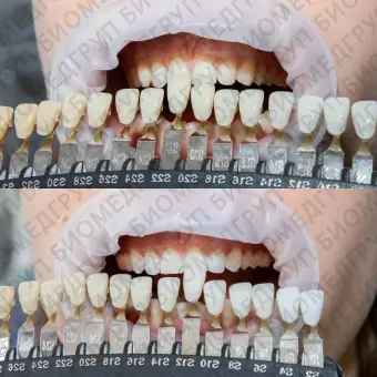 Amazing White Premium Teeth Whitening Kit 38  набор для клинического отбеливания