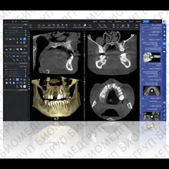 Программное обеспечение для обработки снимков зубов Planmeca Romexis 6.0