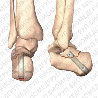 Интрамедуллярный штифт для пяточной кости CALCANAIL