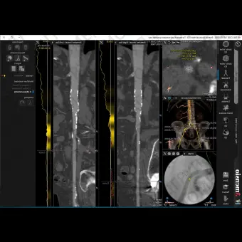 Медицинское программное обеспечение 3mensio Aortic valve