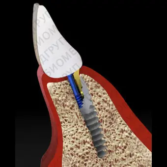 Цилиндрический зубной имплантат B1