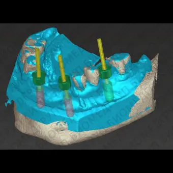 Программное обеспечение для стоматологической хирургии coDiagnostiX