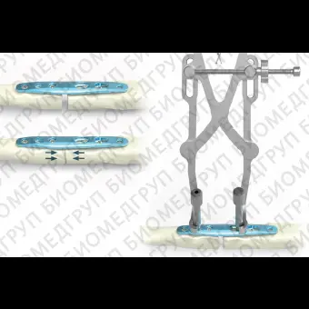 Костная пластина для остеотомии локтевая кость ARIX 2.8