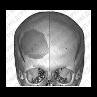 Черепной имплантат на заказ evoShape