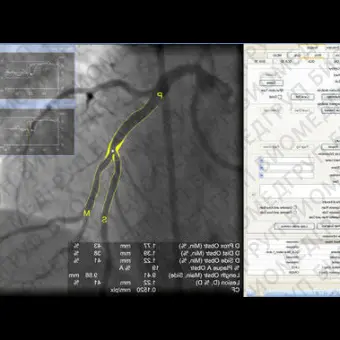 Программное обеспечение для ангиографии CAAS XA