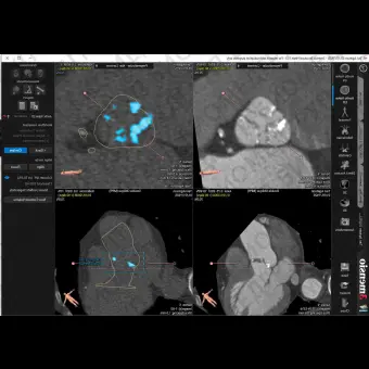 Медицинское программное обеспечение 3mensio Aortic valve