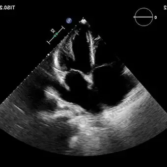 Philips EPIQ CVx Аппарат УЗИ