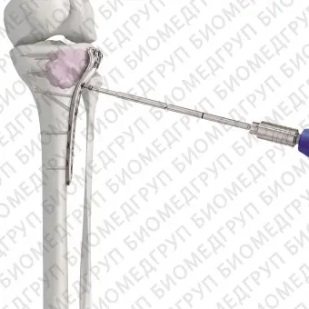 Костный цемент для ортопедической хирургии NORIAN