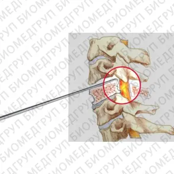 Нейрохирургическая кюретка