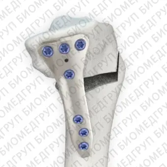 Костная пластина для остеотомии для мыщелка бедренной кости LOQTEQ 4.5